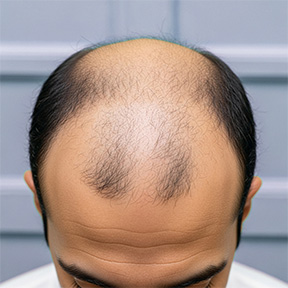 علاج تساقط الشعر والصلع