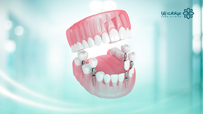 تجربتي-مع-زراعة-الأسنان-الدمام