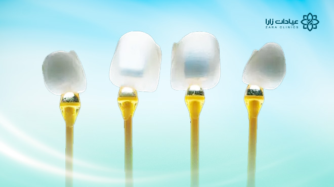 عدسات-الأسنان-الايماكس