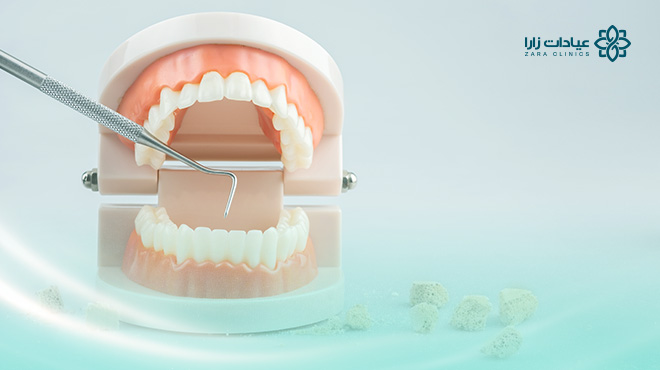 كيفية-ازالة-الجير-من-الاسنان