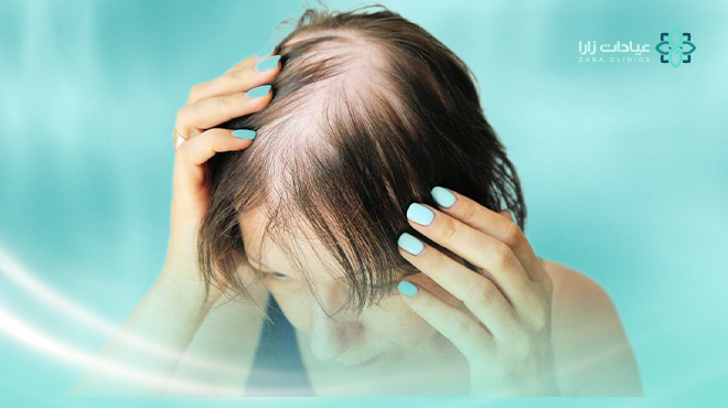 ما-هو-علاج-الصلع-الوراثي-عند-النساء؟