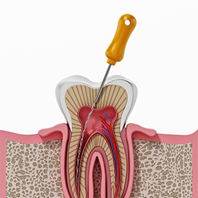 Root Canal Treatment