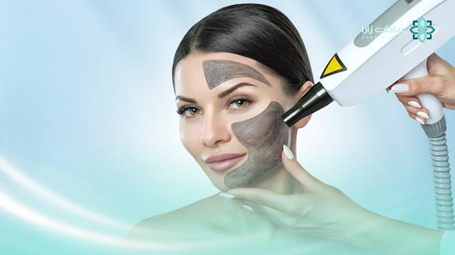 ماهو-الليزر-الكربوني