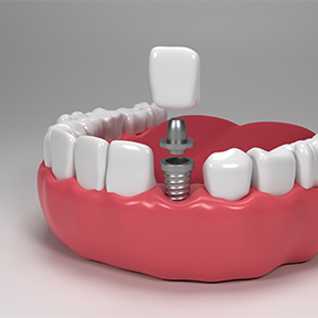 Dental Implants
