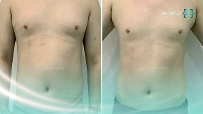 جهاز-ليبوسيل