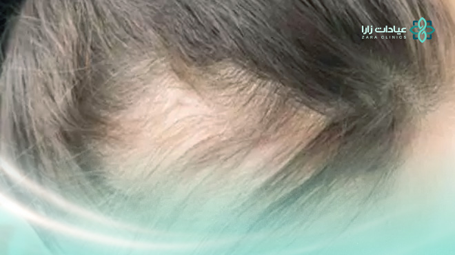 ما-هو-علاج-الصلع-الوراثي-عند-النساء