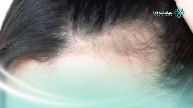 متى-يبدأ-الصلع-الوراثي-عند-النساء