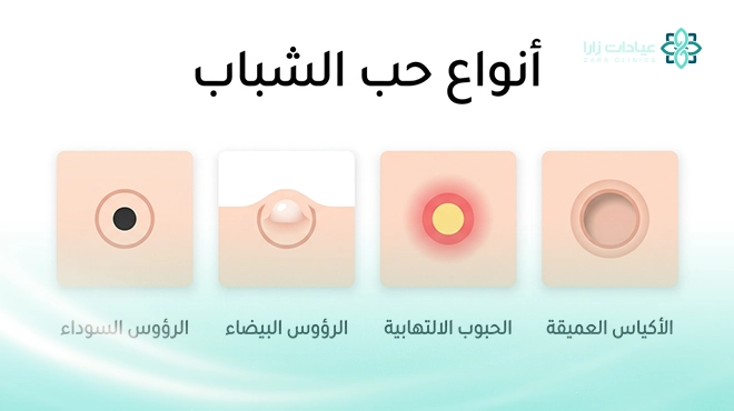 صورة-توضح-ما-هي-انواع-حب-الشباب