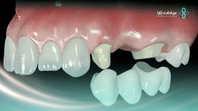 ما-هي-تركيبات-الزيركون