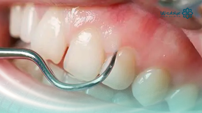 فوائد-ازالة-الجير-من-الاسنان