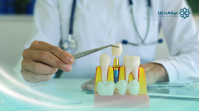 أسعار-زراعة-الأسنان-في-الدمام