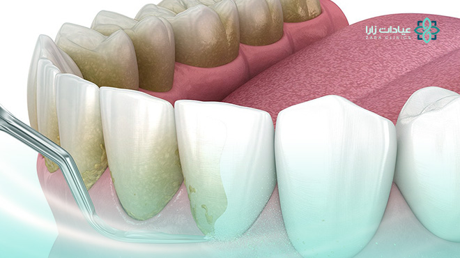 كيفية-ازالة-الجير-من-الاسنان