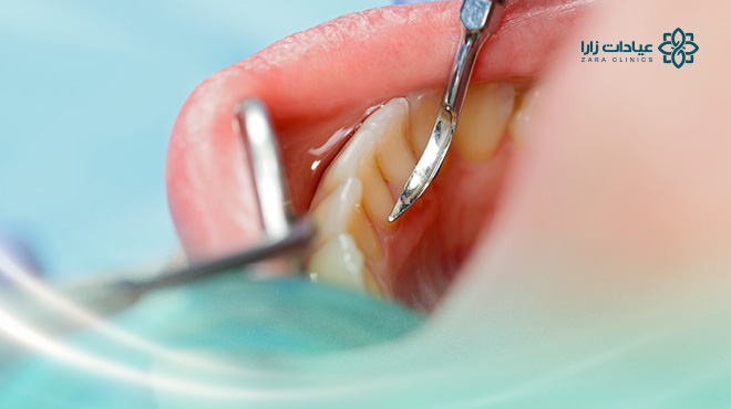 هل-ازالة-الجير-يضعف-الاسنان