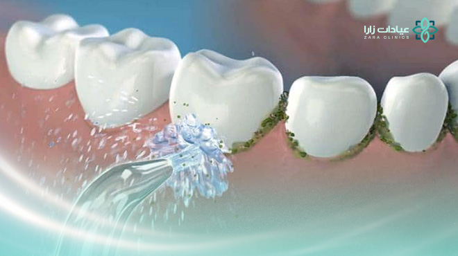 طريقة-ازالة-الجير-من-الاسنان