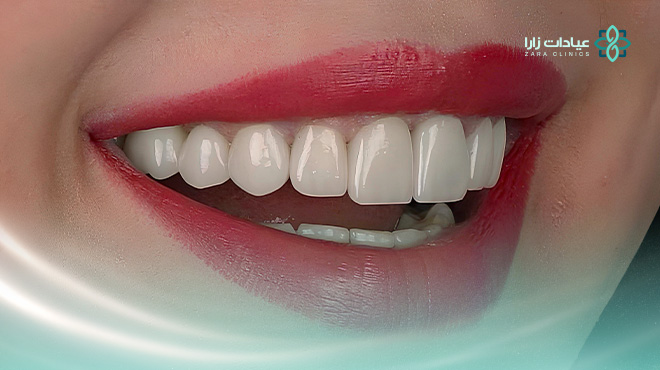 ماهي-عدسات-الايماكس