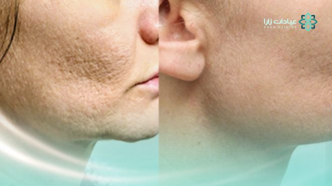 فوائد-جهاز-سكارليت-للبشره