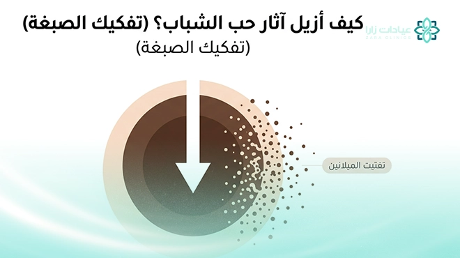 صورة-توضح-كيف-أزيل-آثار-حب-الشباب صورة-توضح-كيف-أزيل-آثار-حب-الشباب