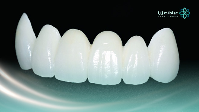 تجربتي-مع-تركيبات-الزيركون