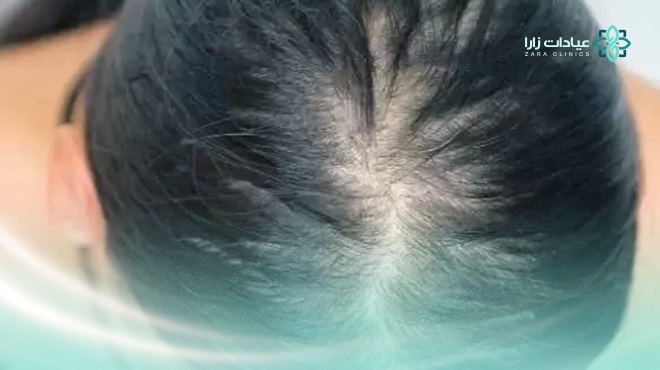 أسباب-الصلع-عند-النساء