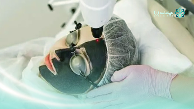 ماهو-الليزر-الكربوني