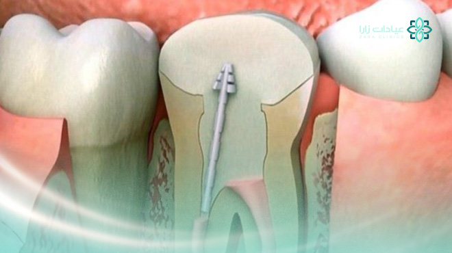 كيفية-علاج-عصب-الاسنان