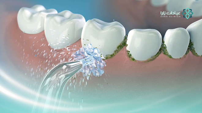 فوائد-خيط-الأسنان-واضراره