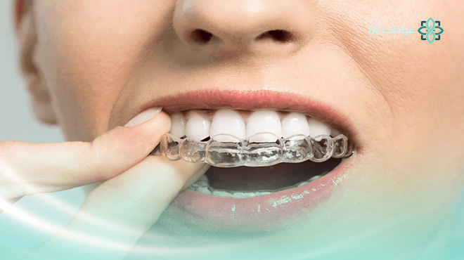 تقويم-الأسنان-المعدني-التقليدي