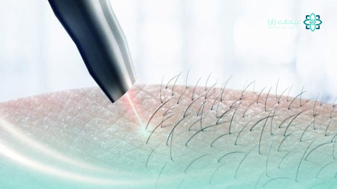 عيادة-ازالة-الشعر-بالليزر-للرجال-الخبر