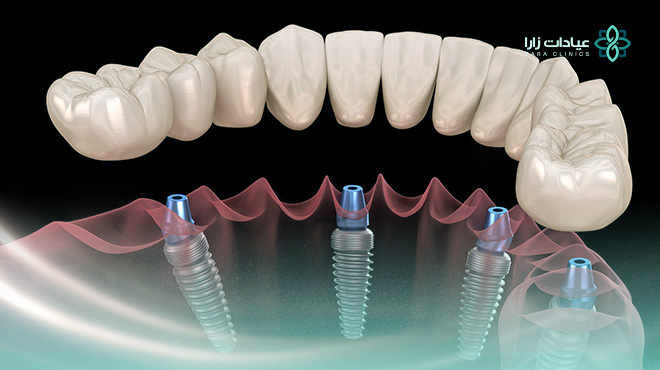 الممنوعات-بعد-زراعة-الأسنان