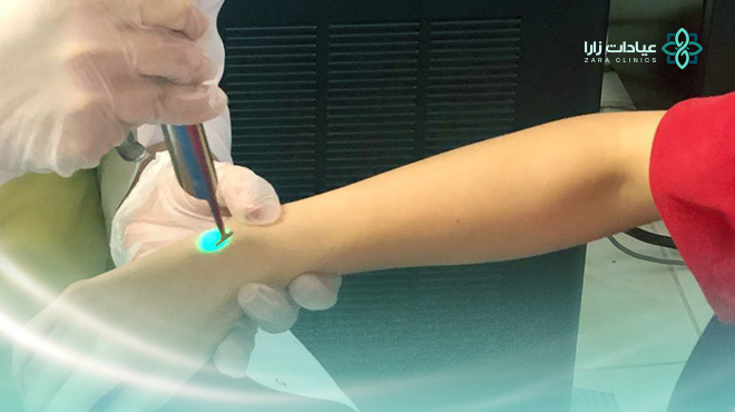 epicare-laser-جهاز
