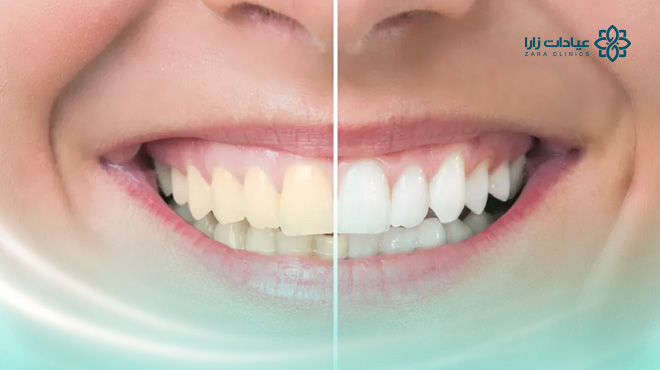 تبييض-الاسنان-بالليزر-قبل-وبعد